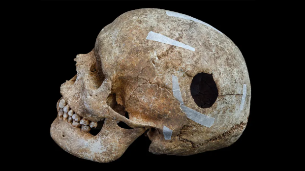 Загонетна гробница из викиншког доба – костури, лобање и остаци џина који је имао операцију мозга