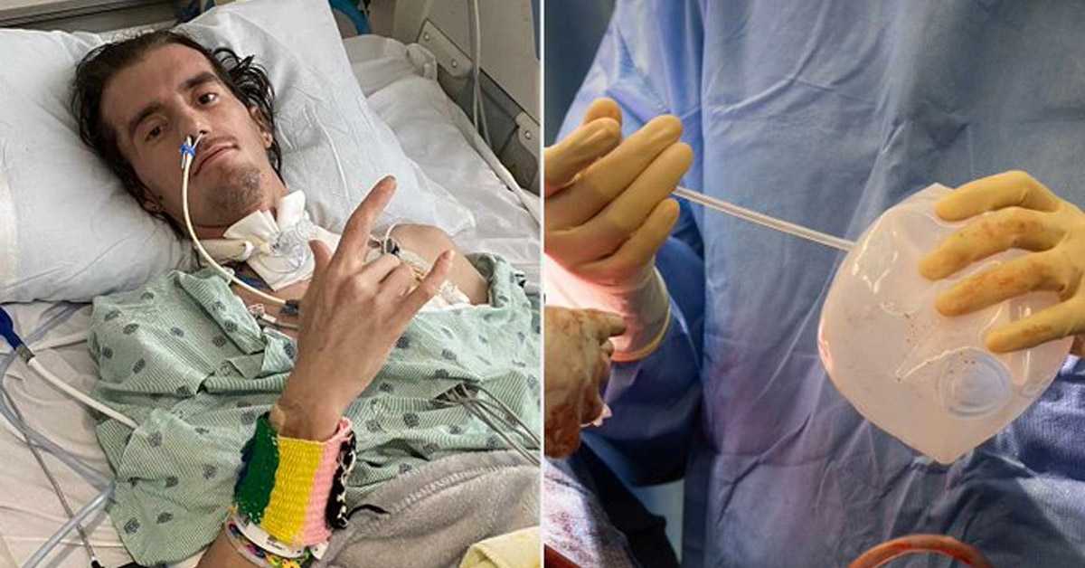 У иновативној процедури, имплантати за груди одиграли кључну улогу у спасавању живота човека са тешким оштећењем плућа