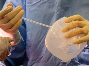 У иновативној процедури, имплантати за груди одиграли кључну улогу у спасавању живота човека са тешким оштећењем плућа