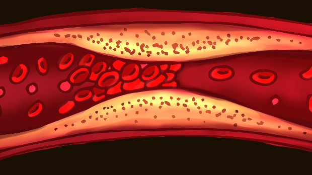 Нове смернице за контролу холестерола: Рани скрининг и превенција у фокусу