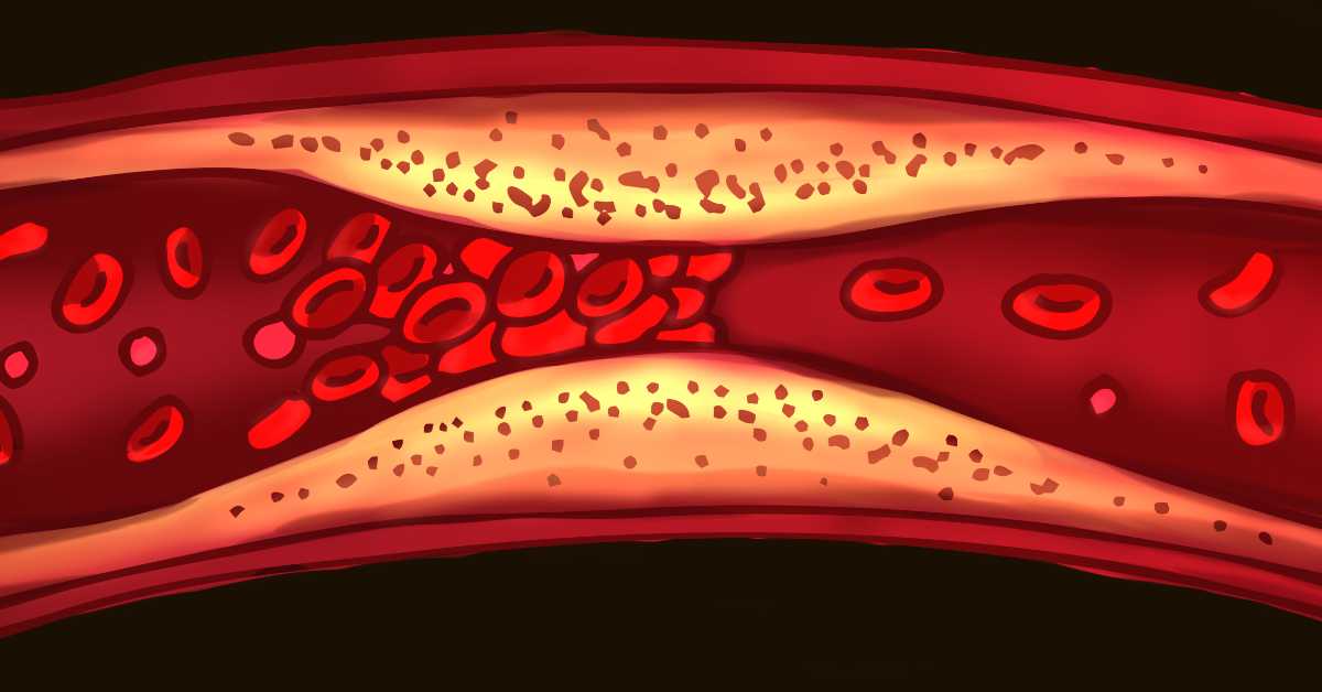 Нове смернице за контролу холестерола: Рани скрининг и превенција у фокусу