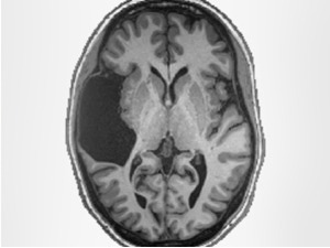 Фали јој лева страна мозга, научници збуњени: Ово нема смисла